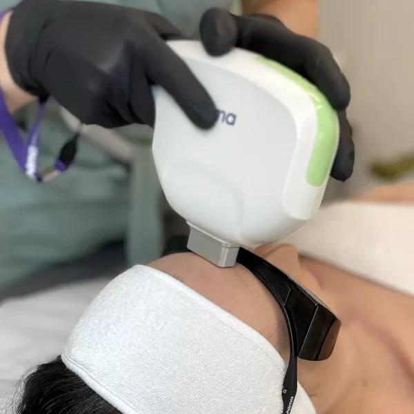 LASEROTERAPIA DYE-VL (redukcja przebarwień, rumienia, zamykanie naczynek)